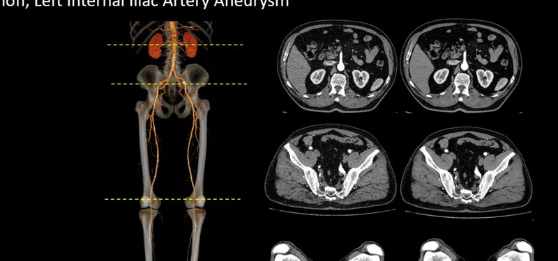 Система компьютерной томографии Philips CT 3500