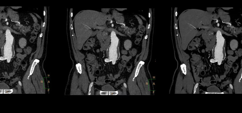 Система компьютерной томографии Philips CT 3500